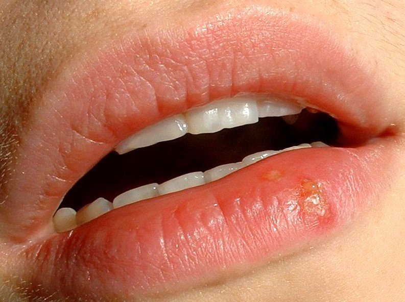 Canker Sores On Lips Images