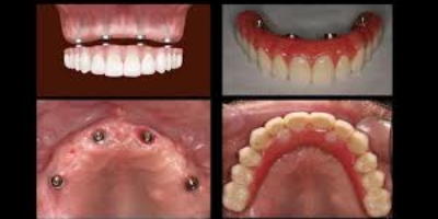 All on 4 Dental Implants Seattle Visuals