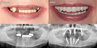 All on 4 Dental Implants Seattle Before & After