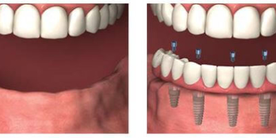 All on 4 Dental Implants Seattle